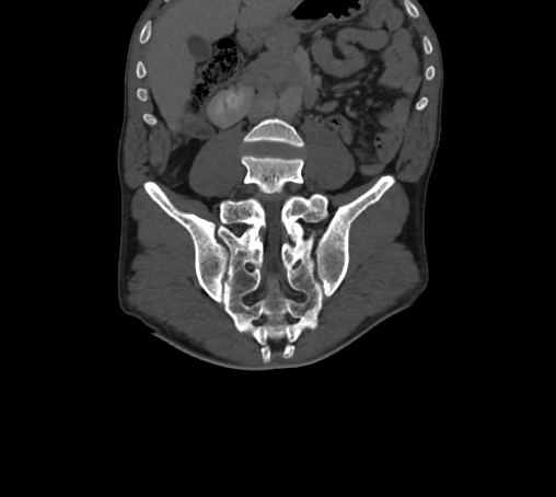 Bronchiectasis in Crohn disease (Radiopaedia 60311-67977 Coronal bone window 43).jpg