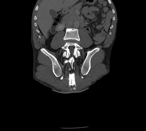 File:Bronchiectasis in Crohn disease (Radiopaedia 60311-67977 Coronal bone window 52).jpg
