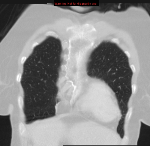 Bronchoalveolar carcinoma (BAC) (Radiopaedia 13436-13392 Coronal lung window 11).jpg