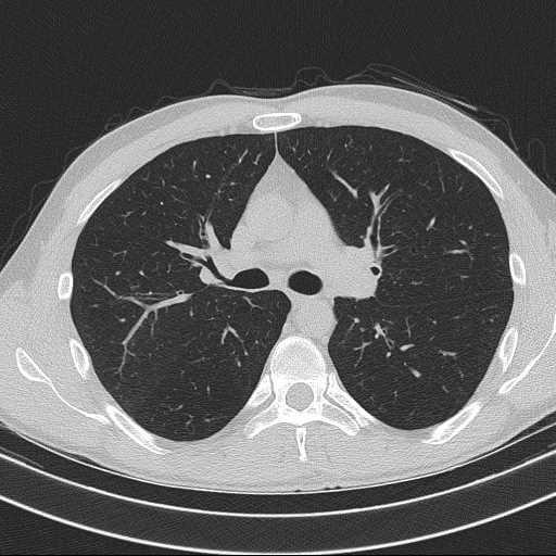 Bronchocele (Radiopaedia 60676-68429 Axial lung window 29).jpg