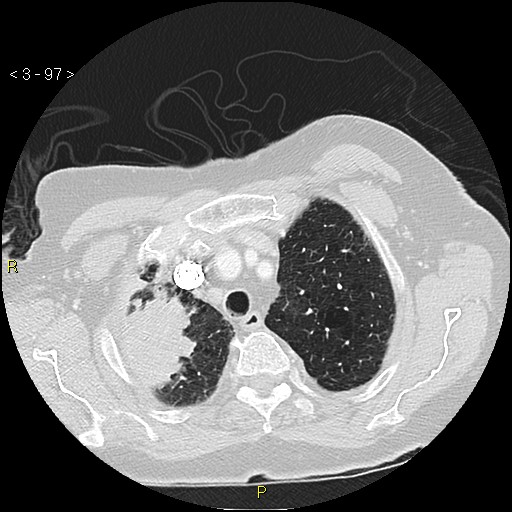 File:Bronchogenic carcinoma as an incidental finding (Radiopaedia 16453-16130 Axial lung window 97).jpg