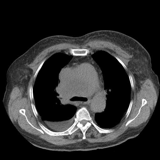 Bronchogenic carcinoma with metastatic lymphadenopathy (Radiopaedia 37671-39569 Axial non-contrast 21).jpg