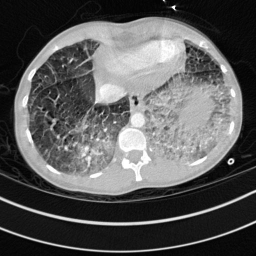 Bronchogenic cyst (Radiopaedia 77801-90071 Axial lung window 72).jpg