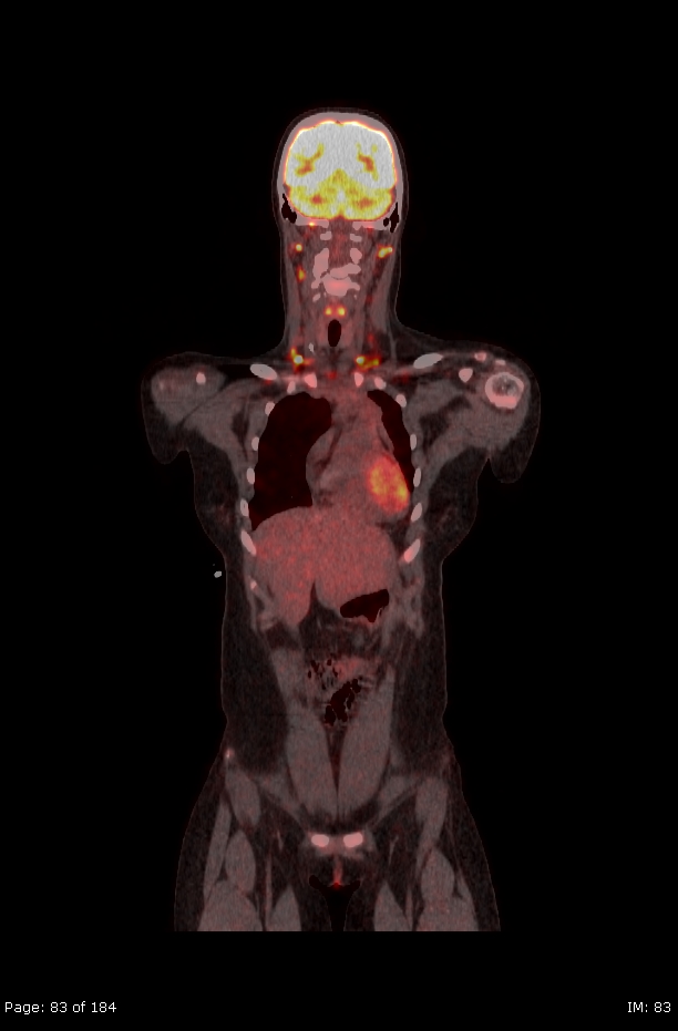 Brown fat uptake (FDG PET-CT) (Radiopaedia 77392-89513 Fused coronal 41).jpg