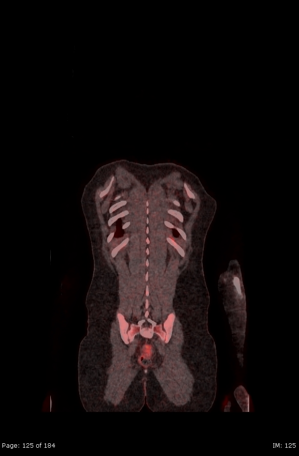 Brown fat uptake (FDG PET-CT) (Radiopaedia 77392-89513 Fused coronal 83).jpg