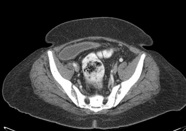 Brown tumors compressing the spinal cord (Radiopaedia 68442-77988 E 101).jpg