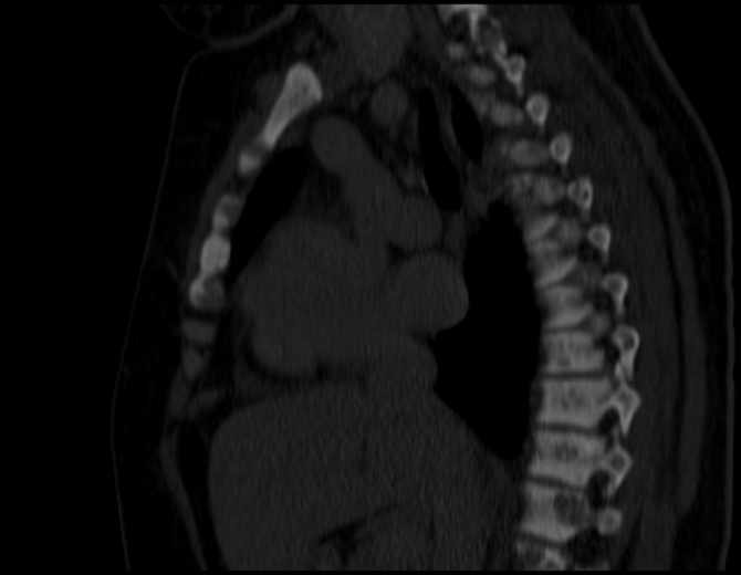 Brown tumors compressing the spinal cord (Radiopaedia 68442-77988 Sagittal bone window 27).jpg