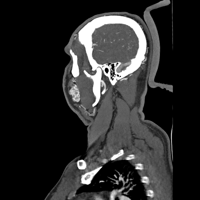 Buccal fat pad arteriovenous malformation (Radiopaedia 70936-81144 C 29).jpg