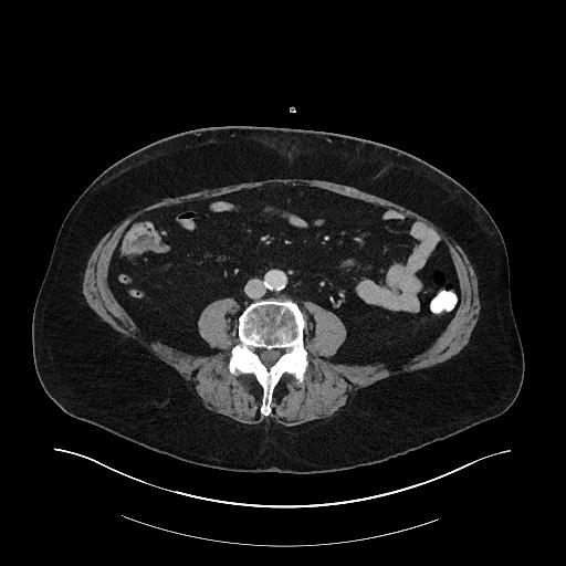 Buried bumper syndrome - gastrostomy tube (Radiopaedia 63843-72575 A 58).jpg