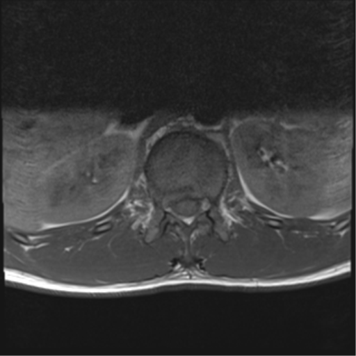 File:Burst fracture - T12 with conus compression (Radiopaedia 56825-63646 Axial T1 16).png