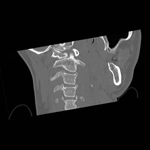 C1-C2 "subluxation" - normal cervical anatomy at maximum head rotation (Radiopaedia 42483-45607 Coronal non-contrast 16).jpg