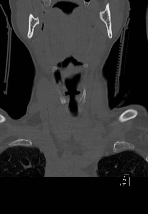 C1 and C2 (peg) fractures (Radiopaedia 36618-38184 Coronal bone window 2).jpg