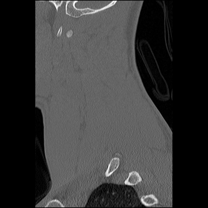 C5 facet fracture (Radiopaedia 58374-65499 Sagittal bone window 56).jpg
