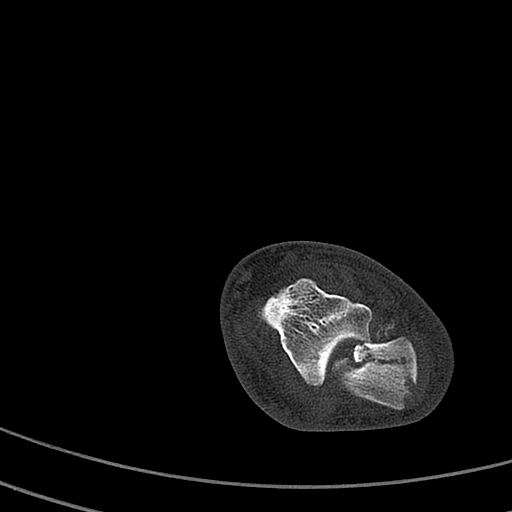 File:Calcaneal fracture - Sanders type 4 (Radiopaedia 90179-107370 Axial bone window 28).jpg