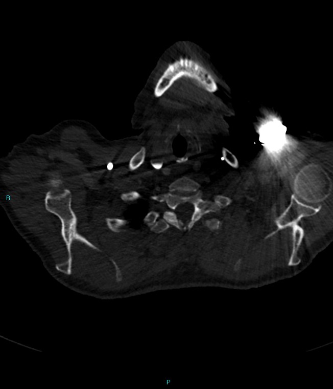 Calcified cerebral emboli from left ventricular thrombus (Radiopaedia 84420-99760 Axial bone window 3).jpg