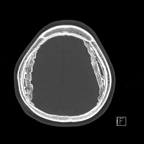 Calcified chronic subdural hematoma (Radiopaedia 77374-89492 Axial bone window 110).jpg