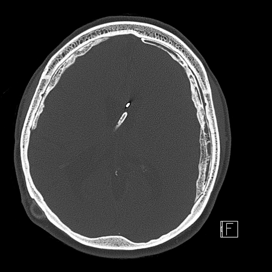 Calcified chronic subdural hematoma (Radiopaedia 77374-89492 Axial bone window 77).jpg