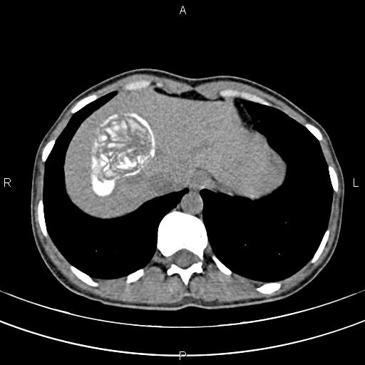 File:Calcified hepatic hydatid cyst (Radiopaedia 83870-99072 Axial non-contrast 22).jpg