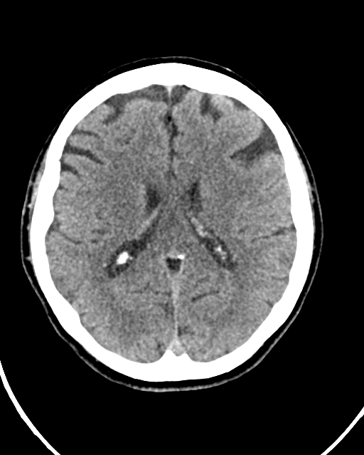 Calcified meningioma (Radiopaedia 74361-85243 Axial non-contrast 22).jpg