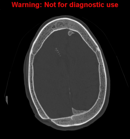 Calvarial thickening from chronic shunting (Radiopaedia 60079-67637 Axial bone window 133).jpg