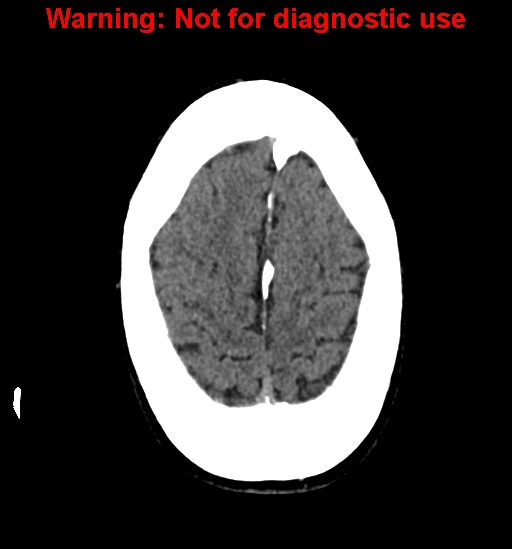File:Calvarial thickening from chronic shunting (Radiopaedia 60079-67637 Axial non-contrast 25).jpg