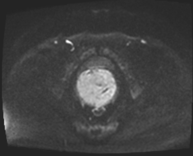 Cancer cervix - stage IIb (Radiopaedia 75411-86615 Axial DWI 71).jpg