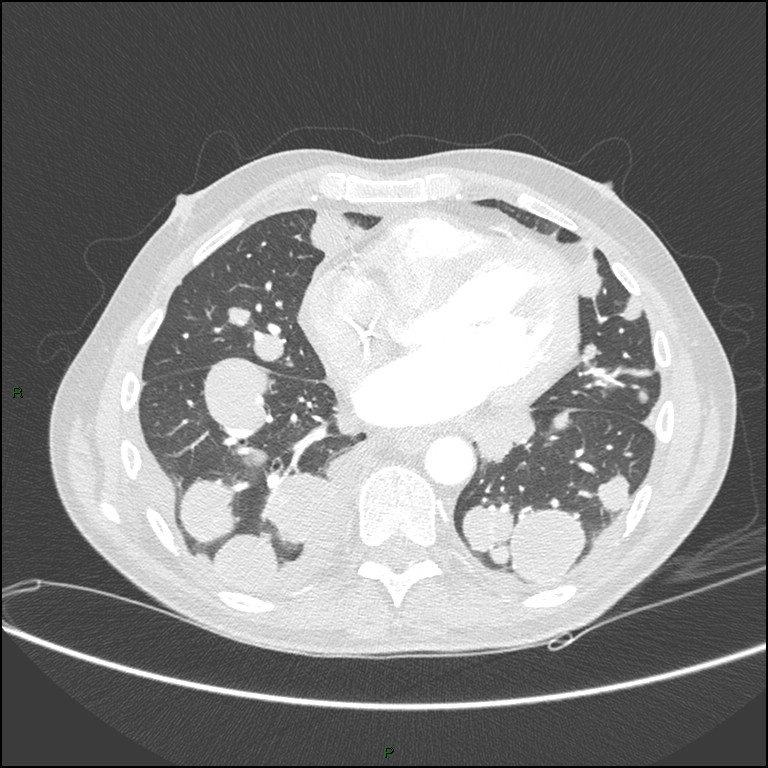 Cannonball metastases (Radiopaedia 82110-96150 Axial lung window 128).jpg
