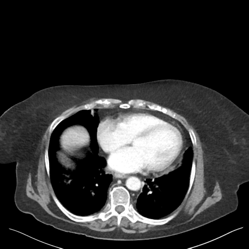 Cannonball metastases from endometrial cancer (Radiopaedia 42003-45031 E 6).png