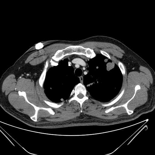 File:Cannonball pulmonary metastases (Radiopaedia 67684-77101 D 58).jpg