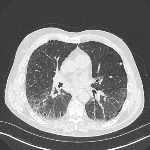 Caplan syndrome (Radiopaedia 56667-63530 Axial lung window 108).jpg
