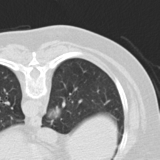 Carcinoid tumor - lung (Radiopaedia 44814-48644 Axial lung window 57).png