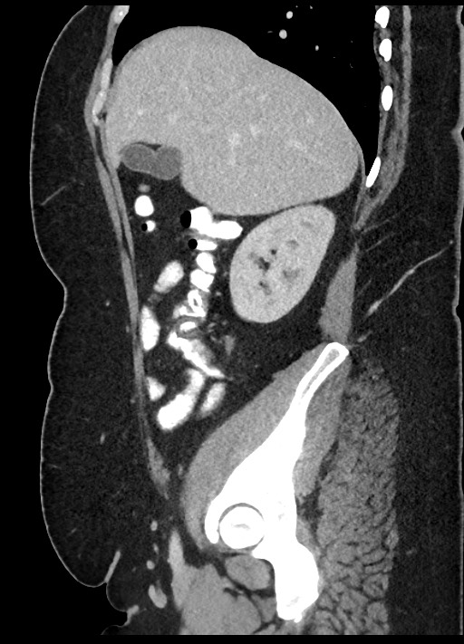 Carcinoid tumor - terminal ileum (Radiopaedia 60931-68739 C 75).jpg