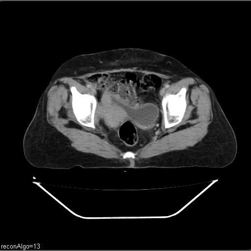 File:Carcinoma cervix- recurrence (Radiopaedia 34702-36137 B 47).jpg