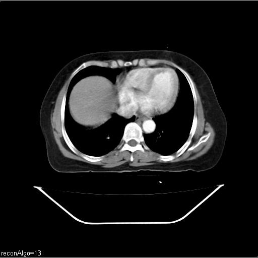 File:Carcinoma cervix- recurrence (Radiopaedia 34702-36137 B 5).jpg