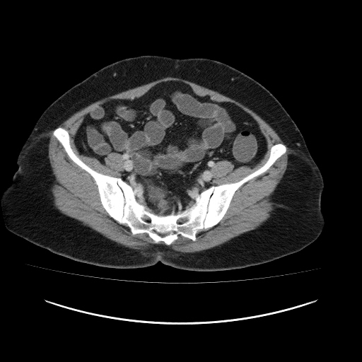 Carcinoma colon - hepatic flexure (Radiopaedia 19461-19493 A 100).jpg