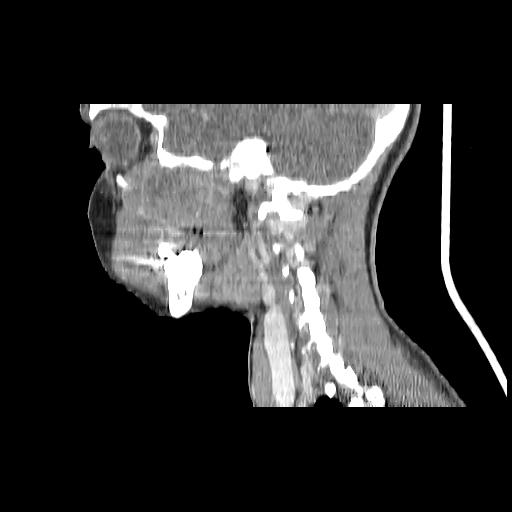 Carcinoma of the maxillary antrum (Radiopaedia 53805-59888 Sagittal C+ delayed 64).jpg
