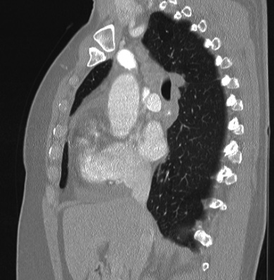 Cardiac sarcoidosis (Radiopaedia 74548-85534 Sagittal lung window 53).jpg