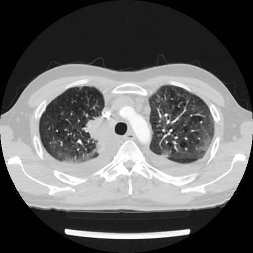 Cardiac tamponade (Radiopaedia 78607-91368 Axial lung window 17).jpg