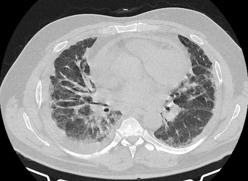 Cardiogenic pulmonary edema (Radiopaedia 68180-77678 Axial lung window 54).jpg