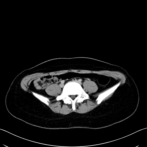 Caroli disease with medullary sponge kidney (Radiopaedia 82622-96804 C 50).jpg