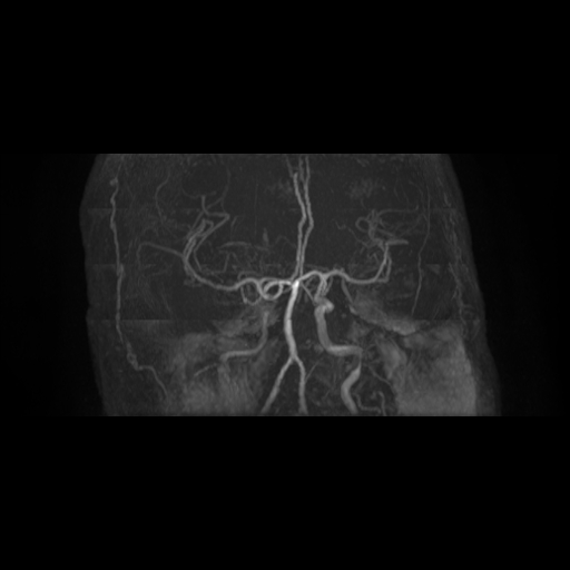 Carotid arterial dissection with acute cerebral infarction (Radiopaedia 26636-26784 MRA 12).jpg