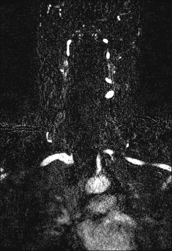 File:Carotid artery dissection (Radiopaedia 28441-28689 Coronal MRA 46).jpg