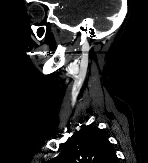 File:Carotid body tumor (Radiopaedia 39845-42300 D 7).jpg