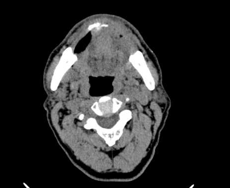 File:Carotid body tumor (Radiopaedia 61750-69757 Axial non-contrast 34).jpg