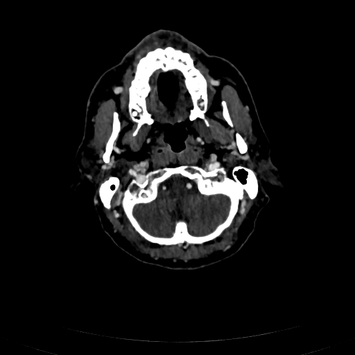 Carotid body tumor (Radiopaedia 83615-98727 D 31).jpg
