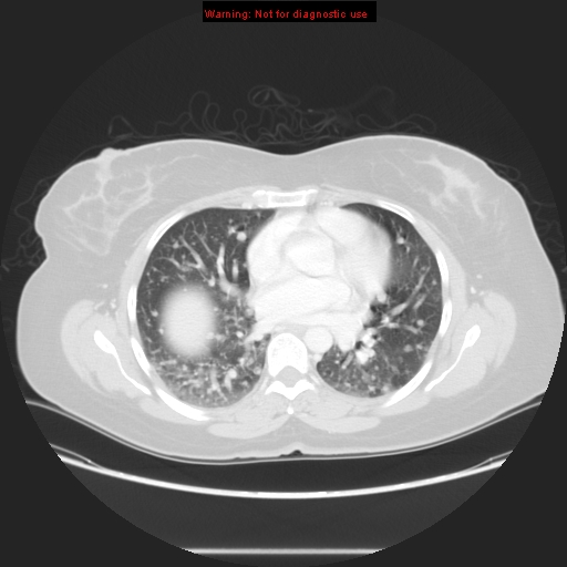Carotid body tumor with lung metastases (Radiopaedia 9301-48390 Axial lung window 40).jpg