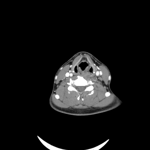 Carotid bulb pseudoaneurysm (Radiopaedia 57670-64616 A 44).jpg