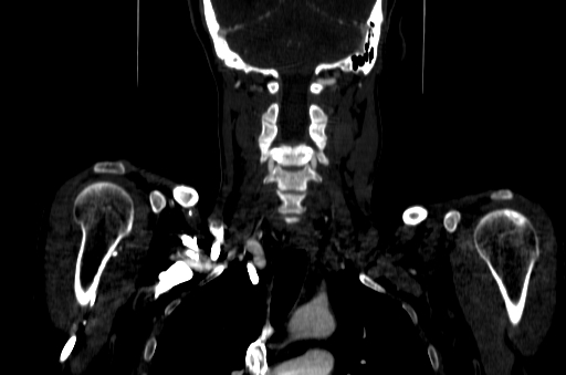 File:Carotid bulb pseudoaneurysm (Radiopaedia 57670-64616 D 51).jpg