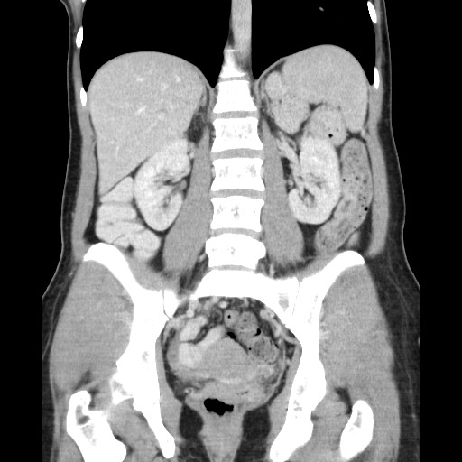 Castleman disease with fibrous pseudotumor in the abdomen (Radiopaedia 77296-89373 B 59).jpg