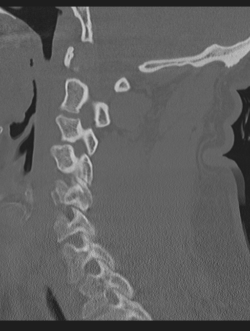 Cavernoma of cervical cord (Radiopaedia 50838-56346 Sagittal bone window 34).png